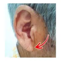 Earlobe